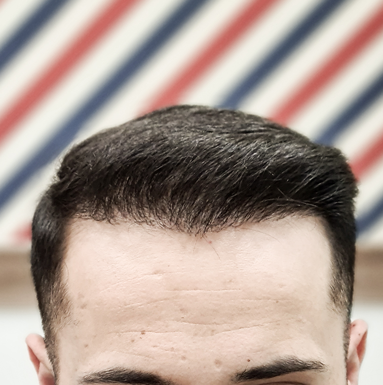 Ein männlicher Patient, der vorher-nachher Fotos von seiner Haartransplantation macht