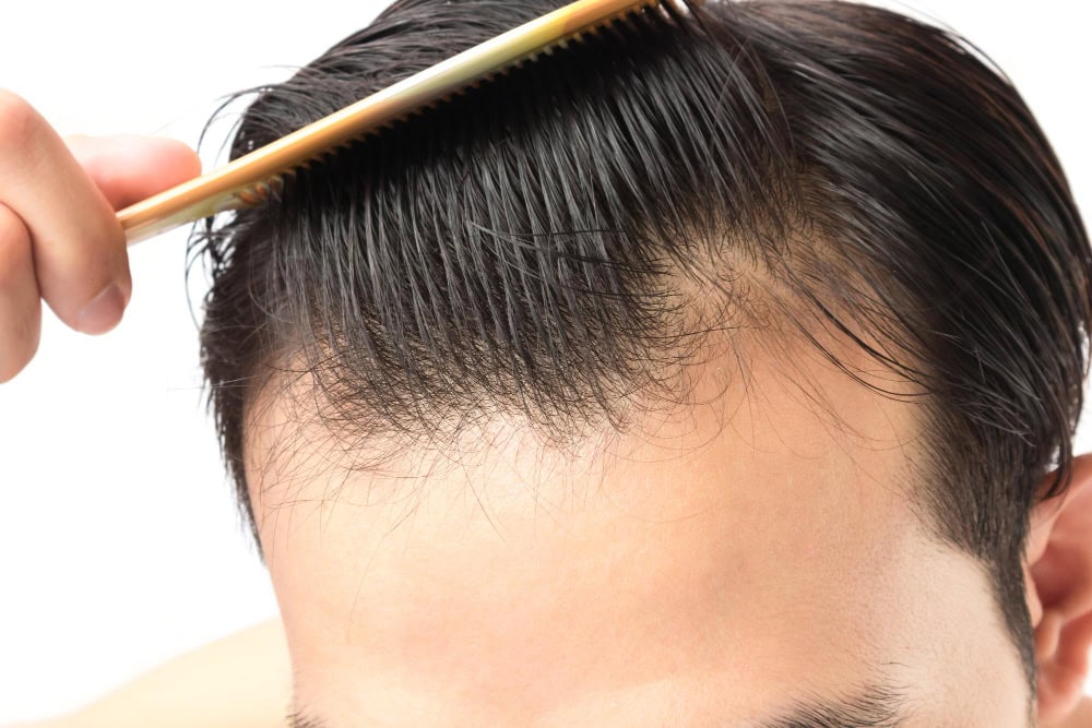 Ein Mitarbeiter, der sich nach einer Haartransplantation in Deutschland die Haare kämmt.