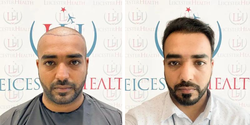 Haartransplantation vorher nachher