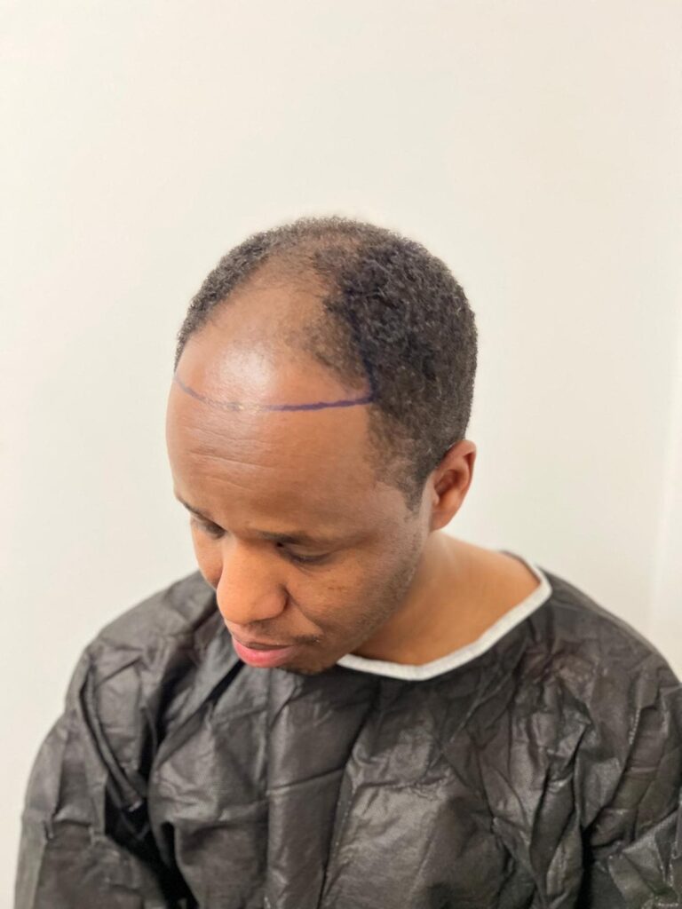 Ein Mitarbeiter, der vor der Afro-Haartransplantation das Haar formt.