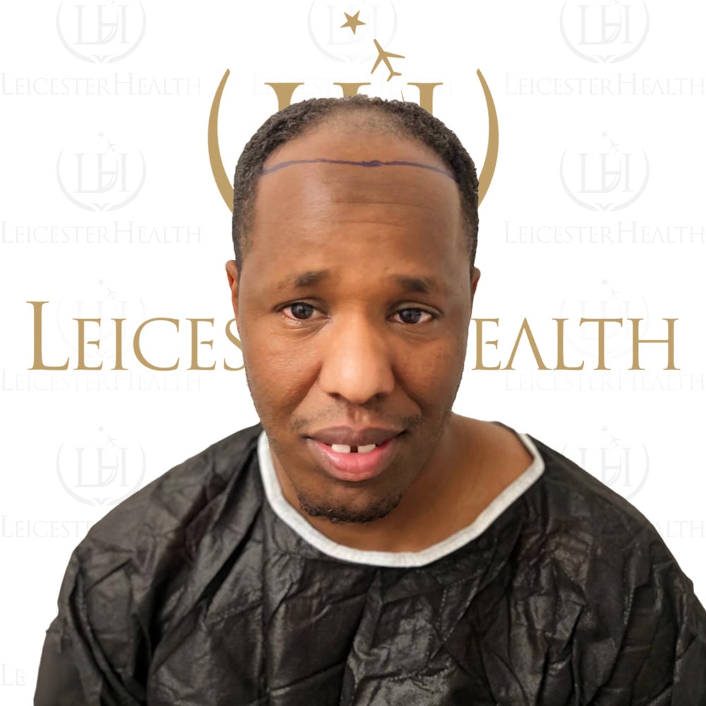 Vorher- und Nachher-Bilder von Afro-Haartransplantationen.