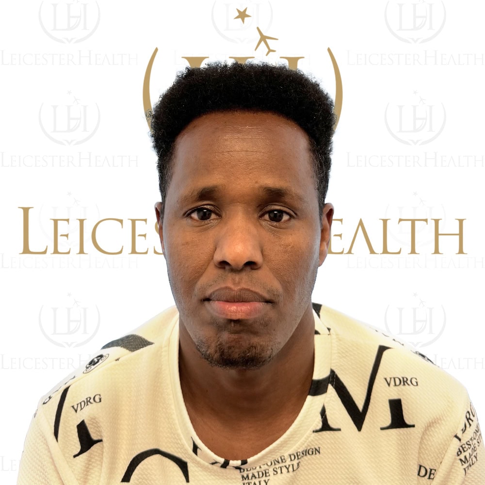 Vorher- und Nachher-Bilder von Afro-Haartransplantationen.
