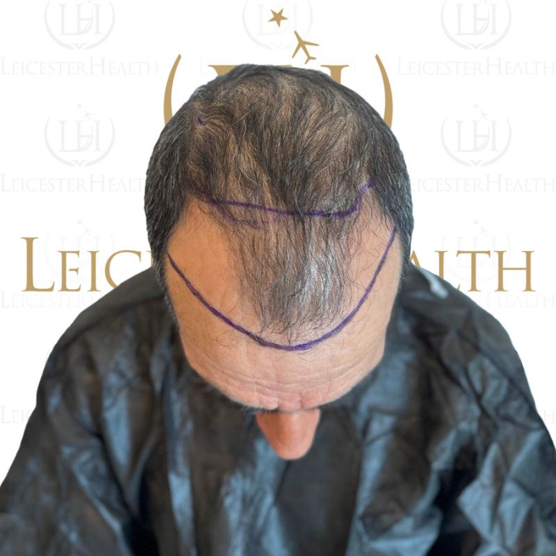 Vorher und Nachher eines Mannes, der in Deutschland eine Haartransplantation mit der Safir-FUE-Methode durchgeführt hat.