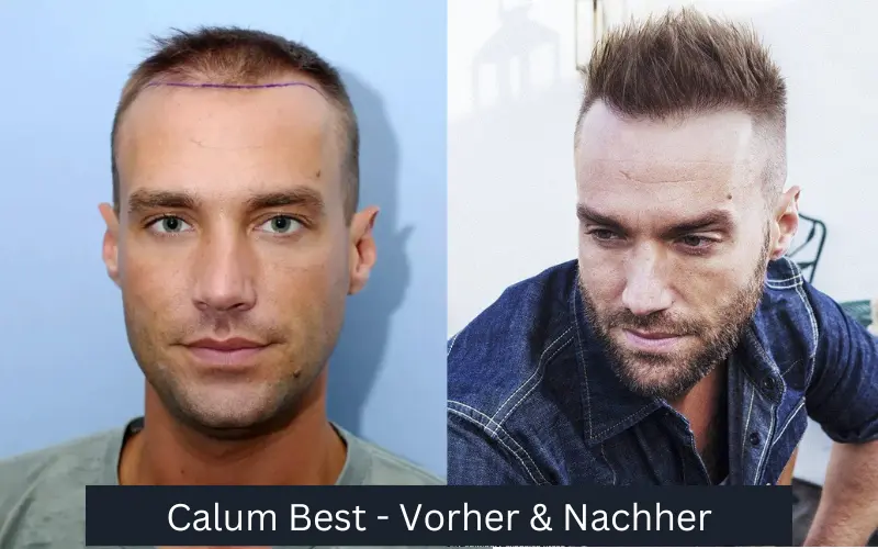 Calum Beste Haartransplantation vorher und nachher