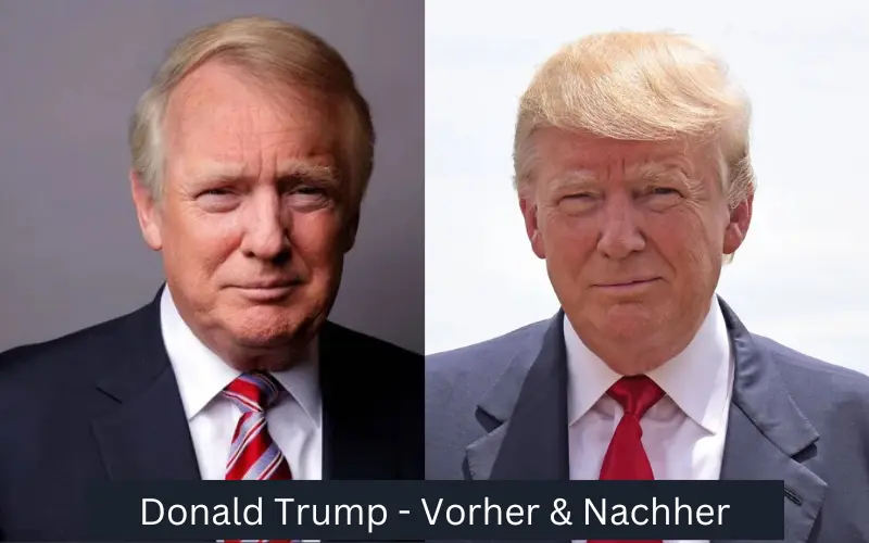 Haartransplantation von Donald Trump vor und nach der Operation