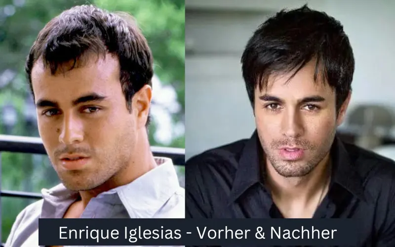 Haartransplantation von Enrique Iglesias vor und nach der Operation