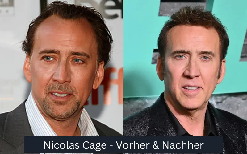 Haartransplantationen für Prominente – Nicolas Cage