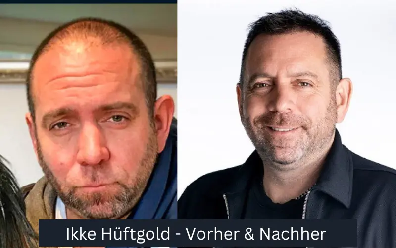 Keine Hüftgold-Haartransplantation – Vorher und Nachher