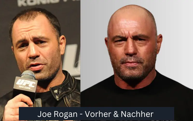 Haartransplantation bei Joe Rogan – Vorher und Nachher