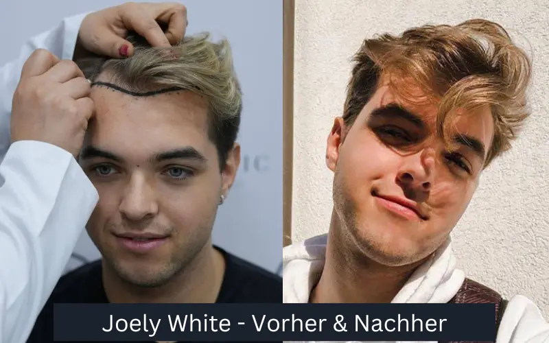 Joely White Haartransplantationen vor und nach