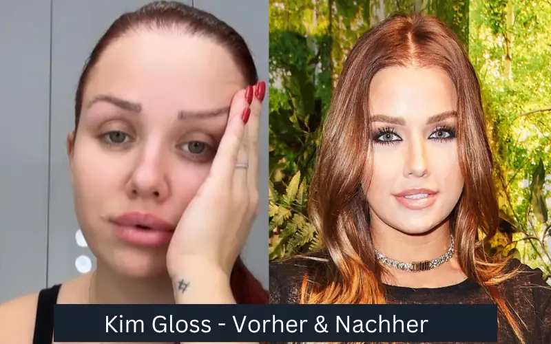 Kim Gloss Haartransplantationen vor und nach