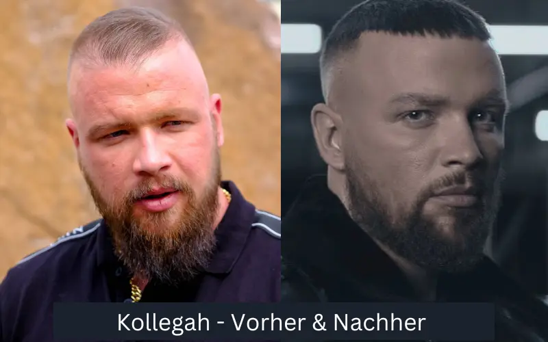 Kollegah-Haartransplantation – Vorher und Nachher