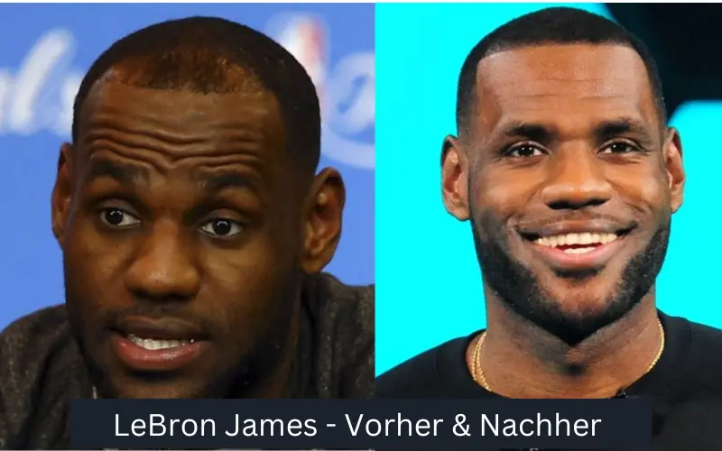 LeBron James Haartransplantationen von Prominenten