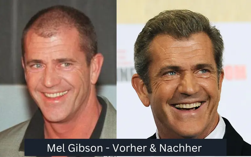 Mel Gibson Haar Transplantation