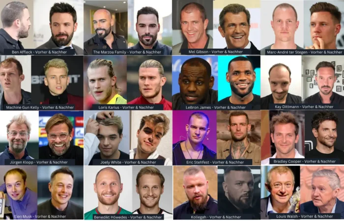 Promis mit Haartransplantation - Vorher & Nachher