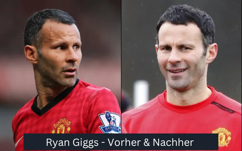 Ryan Giggs Promi-Haartransplantationen