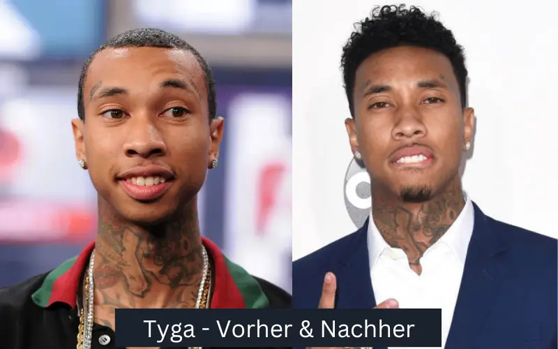 Haartransplantationen der Berühmtheit Tyga vor und nach der Operation